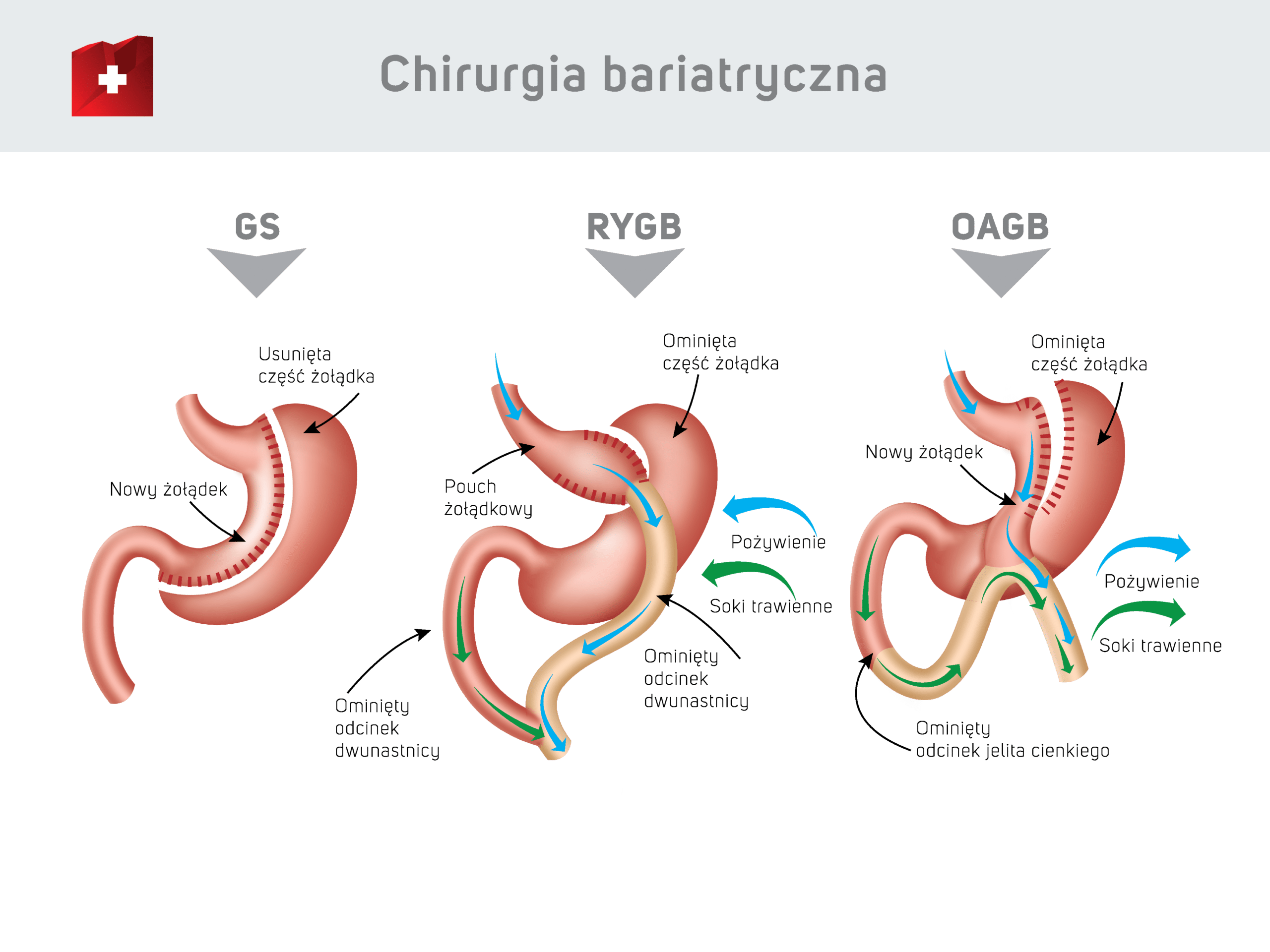 Chrirurgia bariatryczna 11_10 2021 PL Chrirurgia bariatryczna - zabiegi GS / RYGB / OAGB