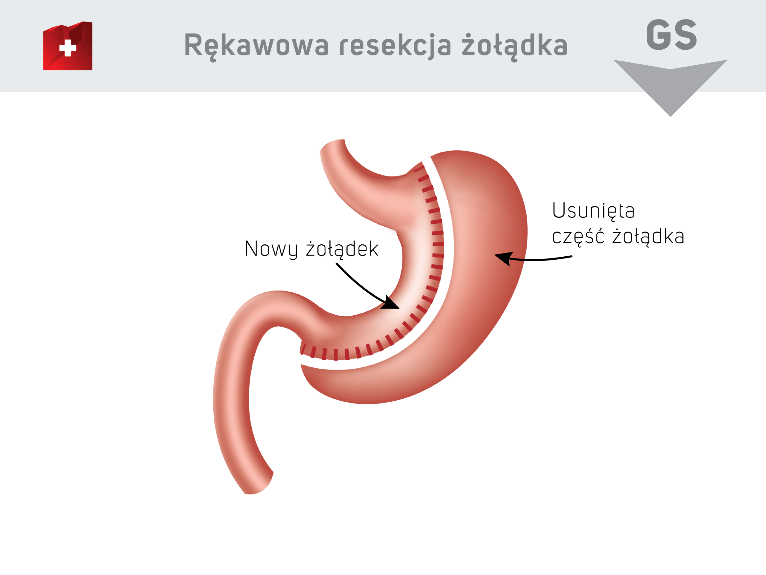 Rękawowa resekcja żołądka 11_10 2021 PL Rękawowa resekcja żołądka - nowy żołądek / usunieta część żołądka
