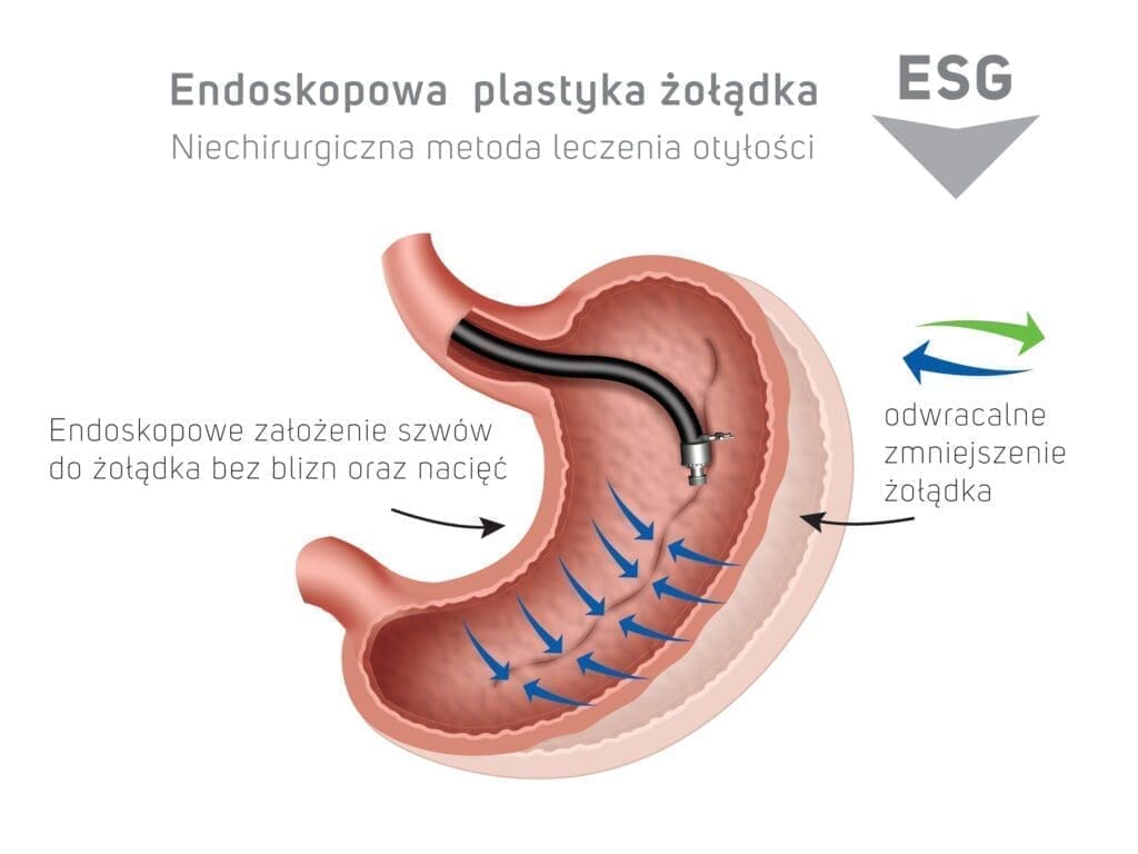 zoladki 6_10 2021 copy-1 Endoskopowa plastyka żołądka ESG - niechirugiczna metoda leczenia otyłości - odwracalne zmniejszenie żołądka