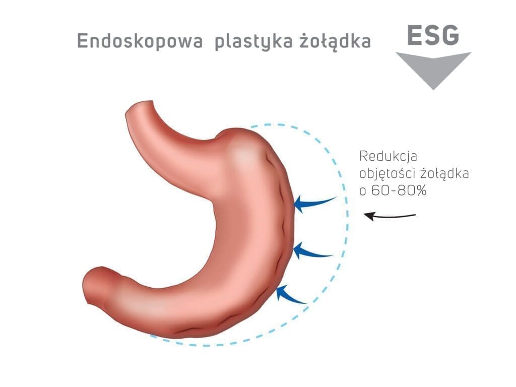 zoladki 6_10 2021 copy-2 Endoskopowa plastyka żołądka ESG - redukcja objętości żołądka o 60-80%