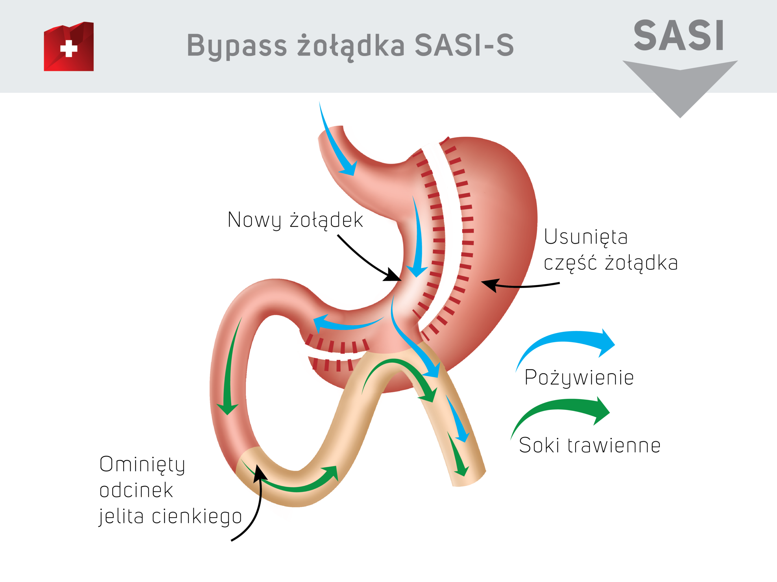 Bypass żołądka SASI-S