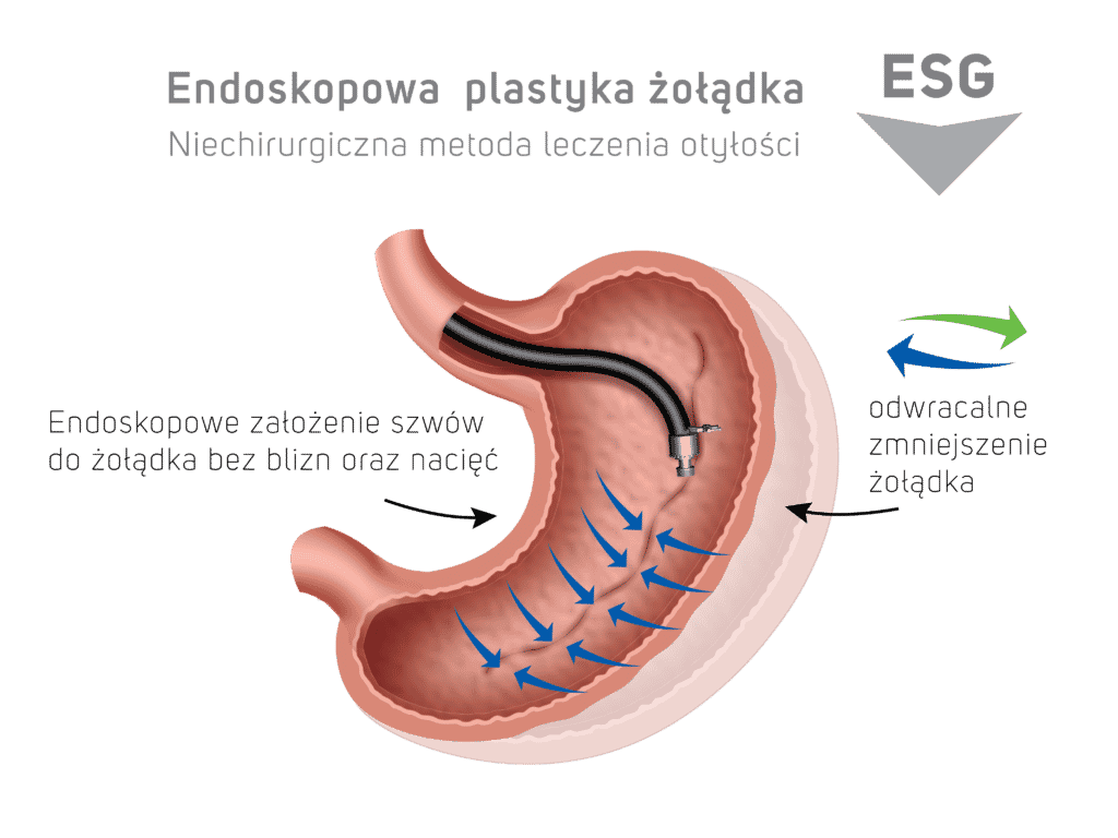 Endoskopowa plastyka żołądka