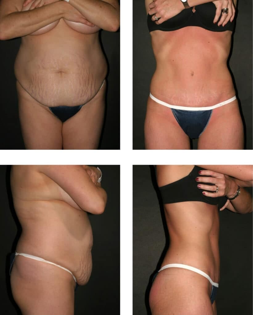 Dr.PlacikAbdominoplasty