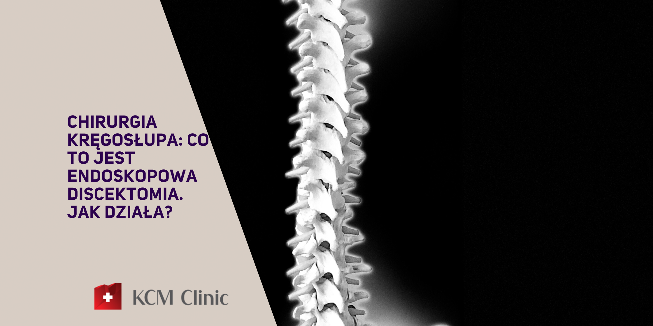 Article Cover (20) Endoskopowa discektomia
