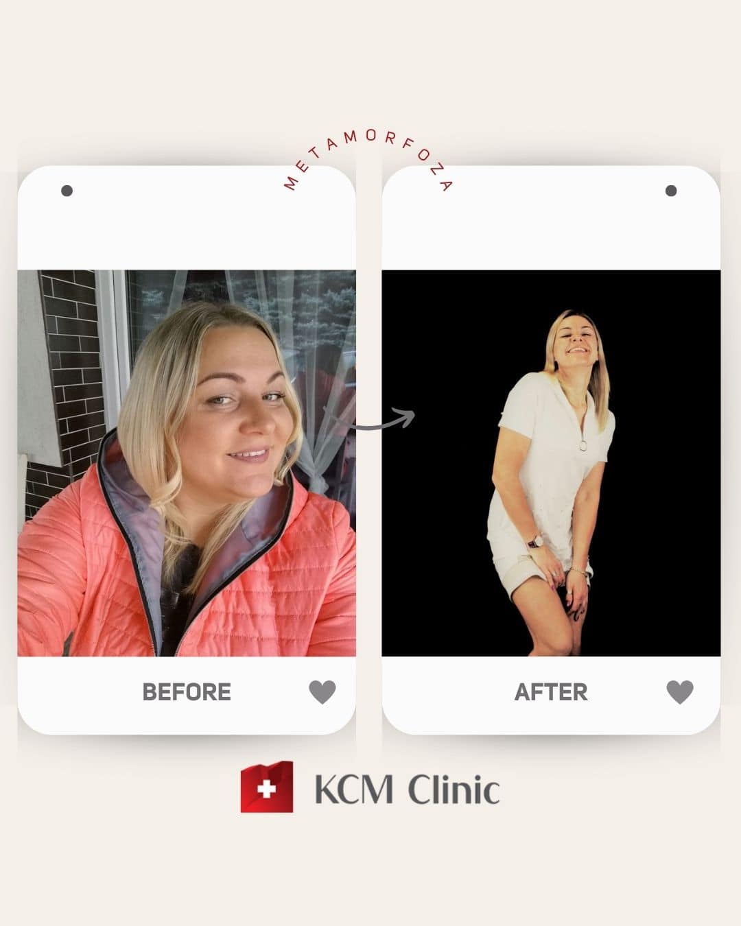 zmniejszenie żołądka weight loss surgery otyłość Bariatria