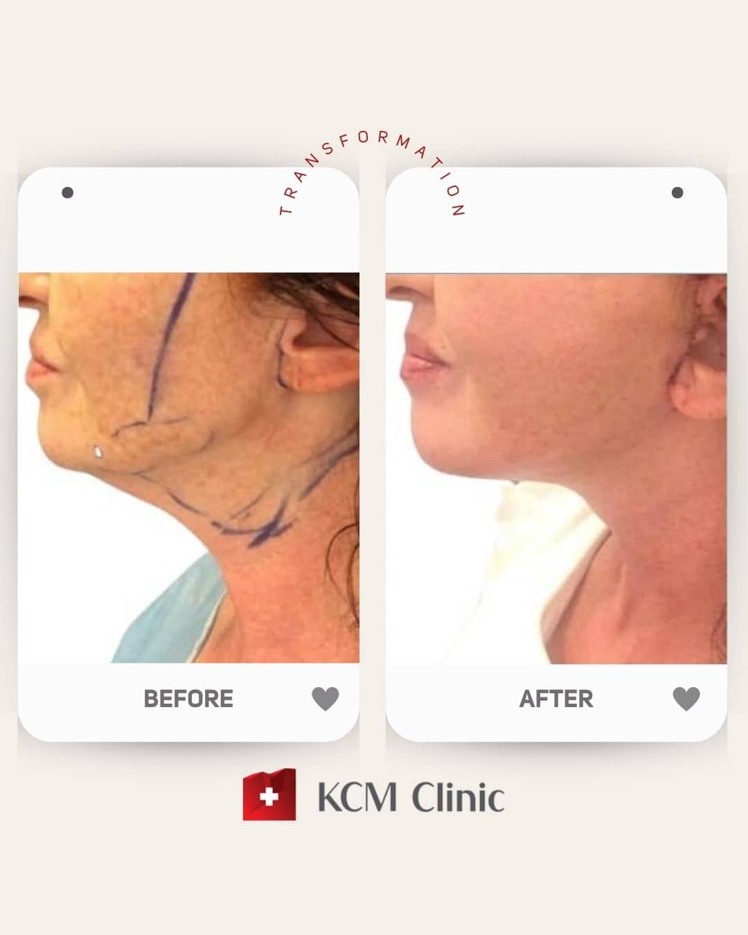 Face and Neck Lifting Plastic Surgery Operacja Plastyczna