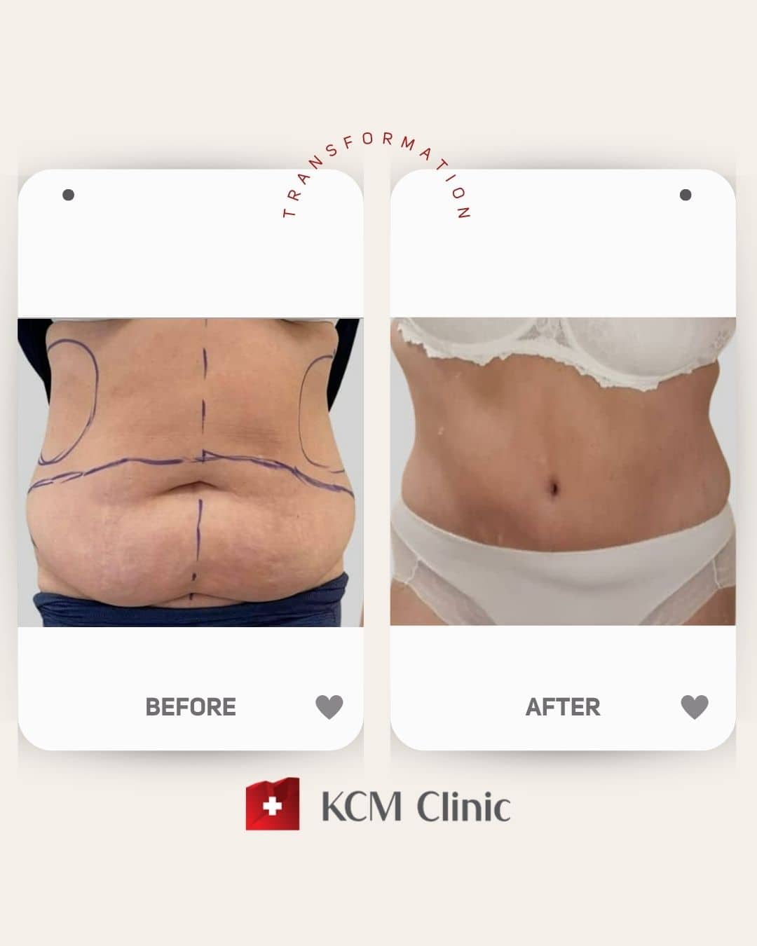 Abdominoplasty with Liposuction Plastic Surgery Operacja Plastyczna