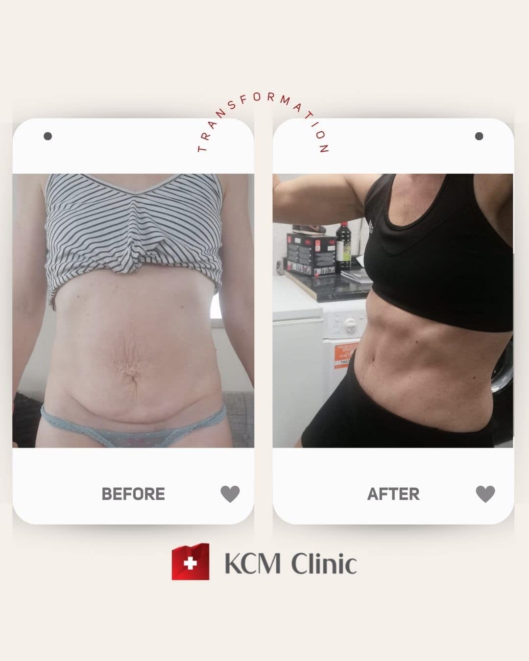 Abdominoplasty with Liposuction Plastic Surgery Operacja Plastyczna