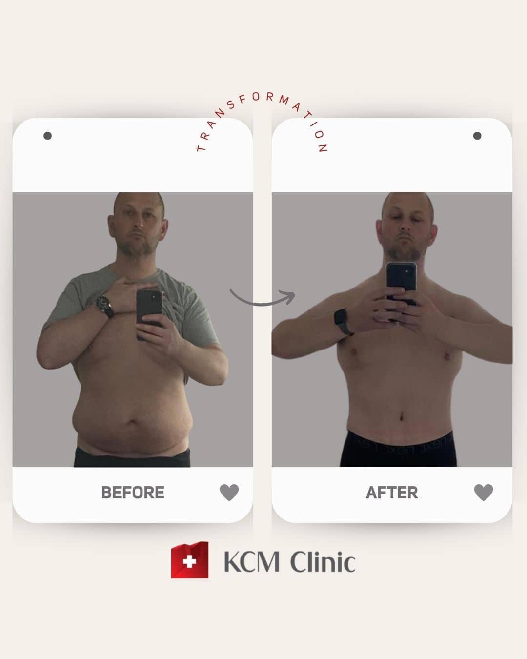 zmniejszenie żołądka Tummy Tuck Butt lift weight loss surgery