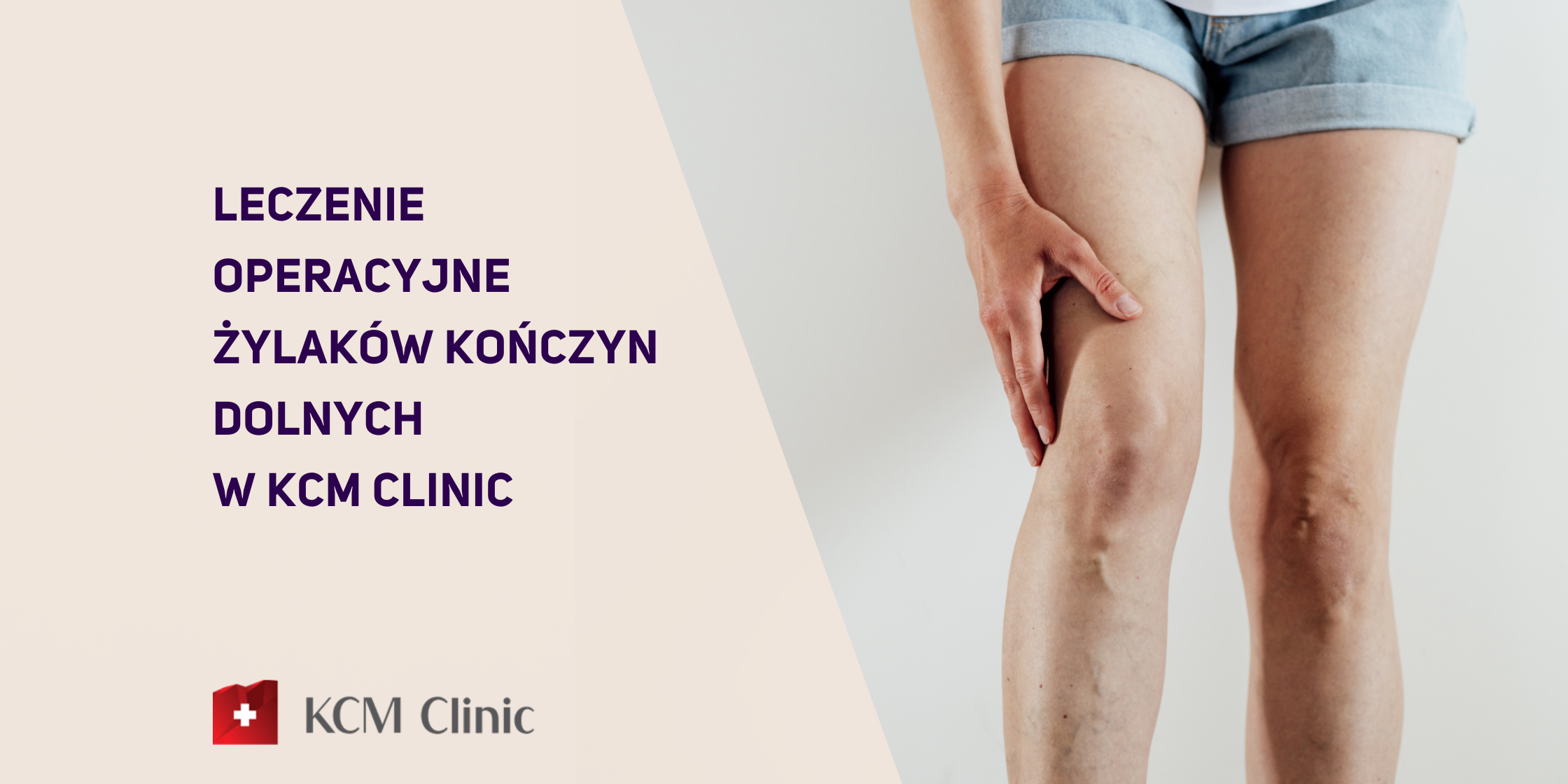 Leczenie operacyjne żylaków